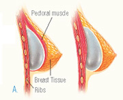 breast_augmentation-4