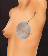 breast_reconstruction-0