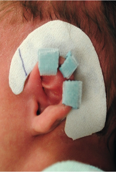 Infant Ear Retractors - EarWell (Ear Mold)