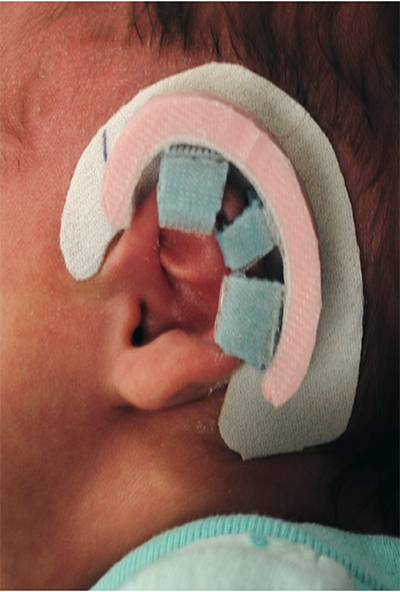 Infant Ear Rim - EarWell (Ear Mold)