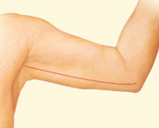 Body Contouring - arm lift