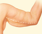 Body Contouring - arm lift