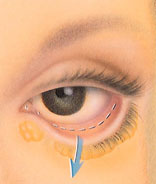 Blepharoplasty Lower Eyelid Incision