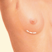 breast_augmentation-1
