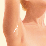 breast_augmentation-3