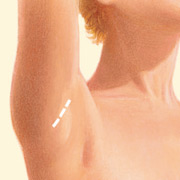 breast_augmentation-3