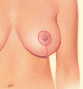 Body Contouring - breast lift
