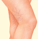 spider_veins-1