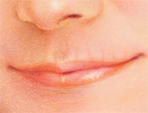 injectable_fillers-4