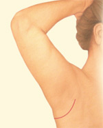 arm-brachioplasty