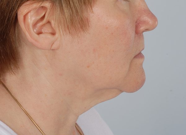 Neck Lift