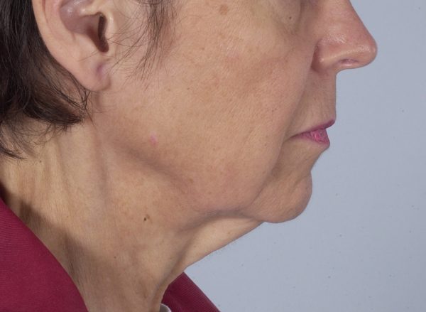 Neck Lift