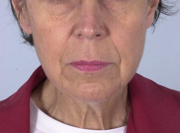 Neck Lift