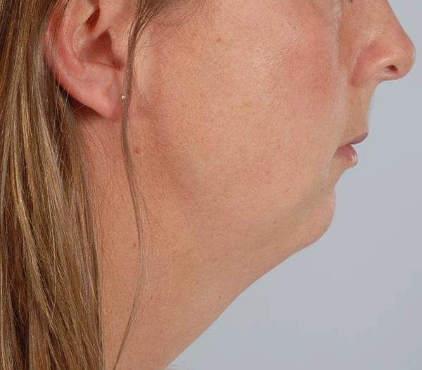 Neck Lift