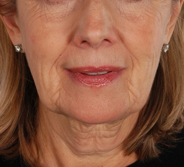 Facelift Case 961 Before Photo Facelift