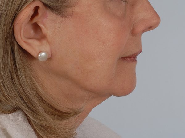 Facelift Case 961 After Photo Facelift