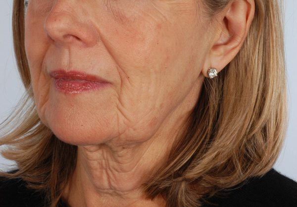 Facelift Case 961 Before Photo Facelift