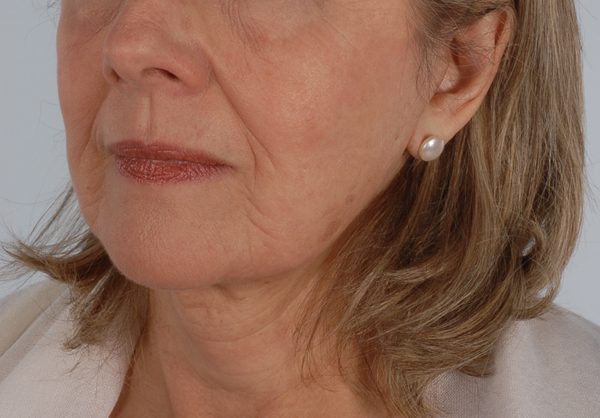 Facelift Case 961 After Photo Facelift