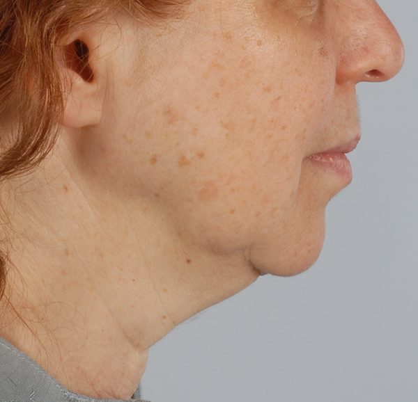 Facelift Case 963 Before Photo Facelift