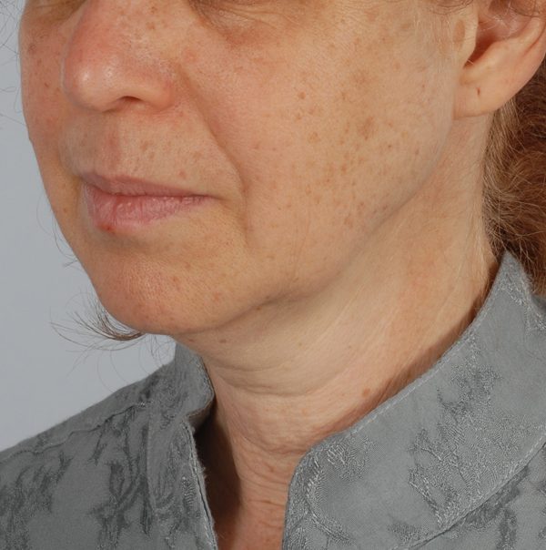 Facelift Case 963 Before Photo Facelift