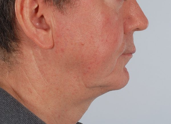 Facelift Case 964 Before Photo Facelift