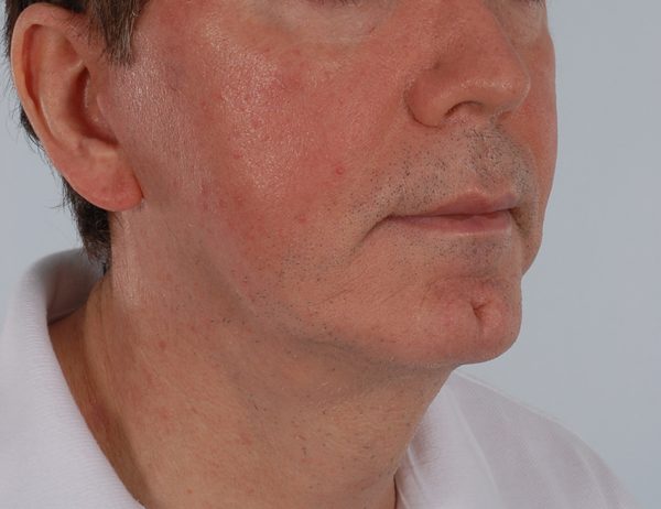 Facelift Case 964 After Photo Facelift