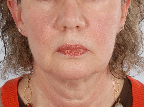 Facelift Case 965 Before Photo Facelift
