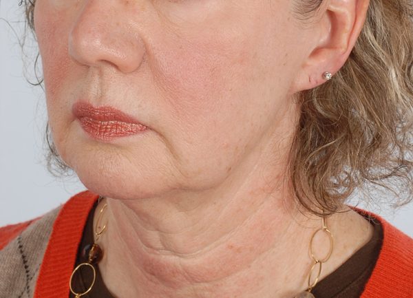 Facelift Case 965 Before Photo Facelift