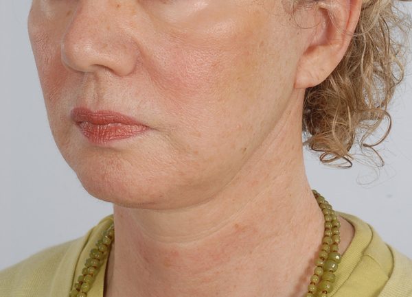 Facelift Case 965 After Photo Facelift