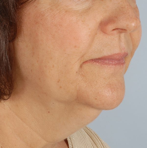 Facelift Case 966 Before Photo Facelift