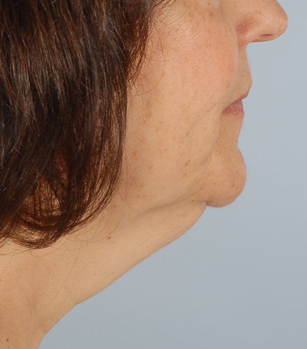 Facelift Case 966 Before Photo Facelift