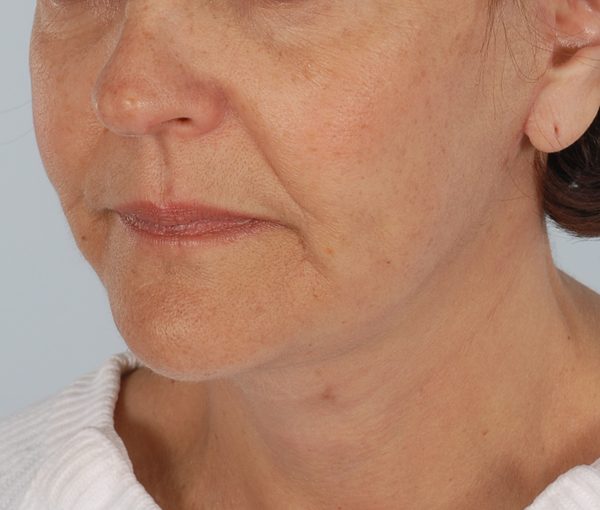 Facelift Case 966 After Photo Facelift