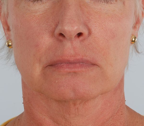 Facelift Case 967 Before Photo Facelift