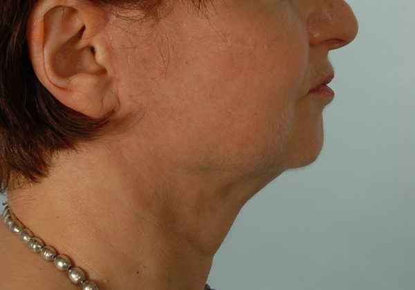 Facelift Case 968 After Photo Facelift