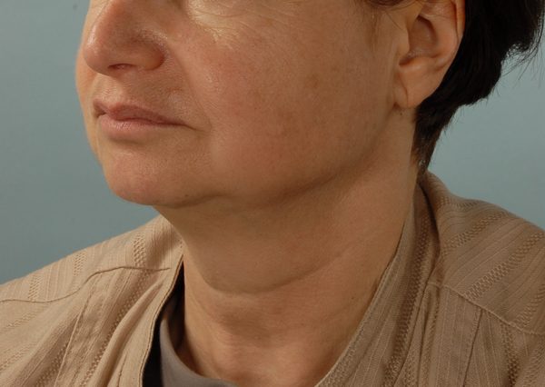 Facelift Case 968 Before Photo Facelift