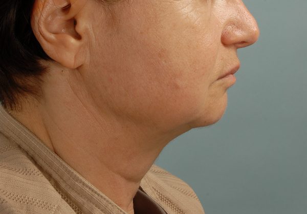 Facelift Case 968 Before Photo Facelift