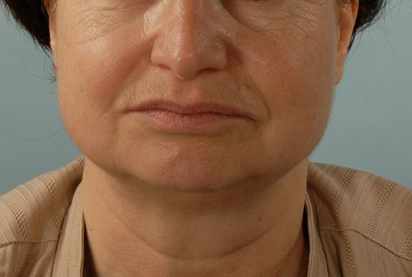 Facelift Case 968 Before Photo Facelift