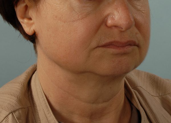 Facelift Case 968 Before Photo Facelift