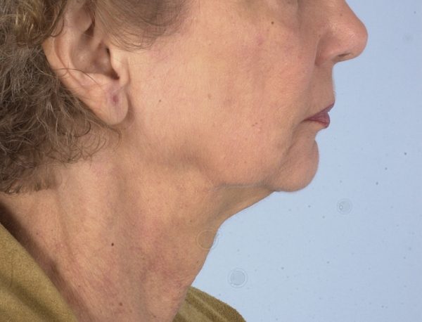 Facelift Case 970 Before Photo Facelift