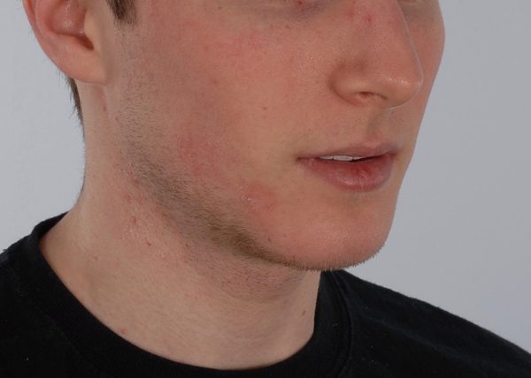Chin Advancement Case 1196 After Photo Chin Advancement