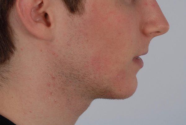 Chin Advancement Case 1196 After Photo Chin Advancement
