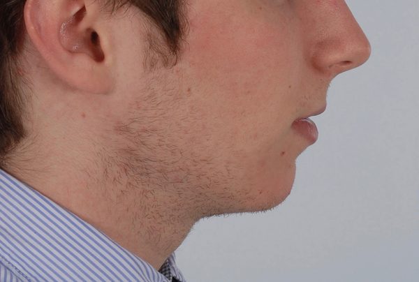 Chin Advancement Case 1196 Before Photo Chin Advancement
