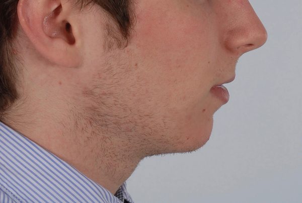 Chin Advancement