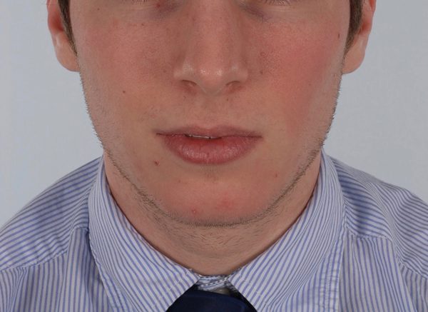 Chin Advancement Case 1196 Before Photo Chin Advancement