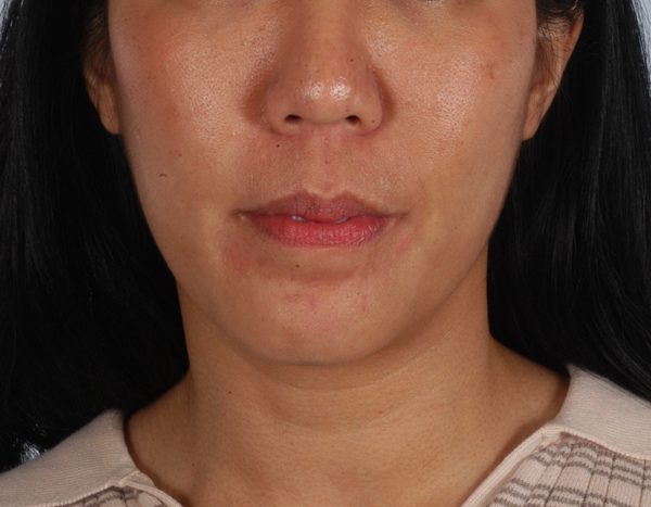 Chin Advancement Case 1198 After Photo Chin Advancement