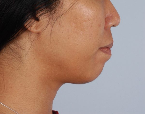 Chin Advancement Case 1198 Before Photo Chin Advancement