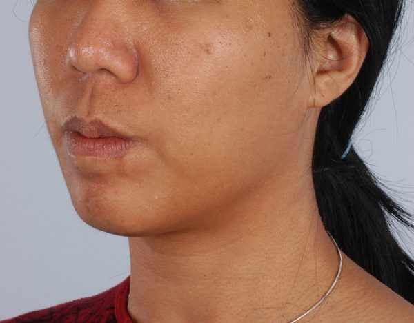 Chin Advancement Case 1198 Before Photo Chin Advancement