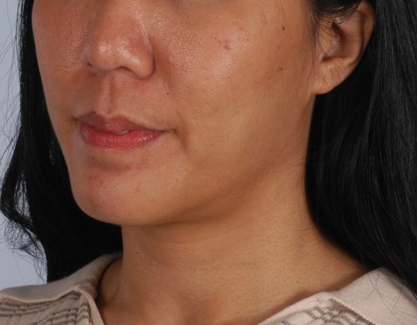 Chin Advancement Case 1198 After Photo Chin Advancement