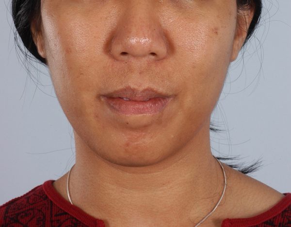Chin Advancement Case 1198 Before Photo Chin Advancement