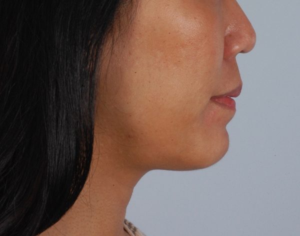 Chin Advancement Case 1198 After Photo Chin Advancement